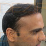 best hair transplant surgeon in India