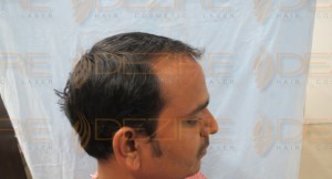 best place for hair transplant in the world