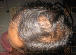 best treatment for thinning hair