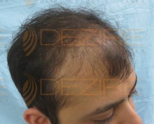 cheapest hair transplant cost in india
