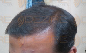 different how many type Hair Transplant