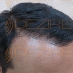 direct hair implantation disadvantages