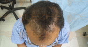 disadvantages of hair transplant in hindi