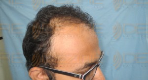 disadvantages of hair transplant surgery