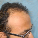 disadvantages of hair transplant surgery