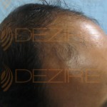 do hair loss products work