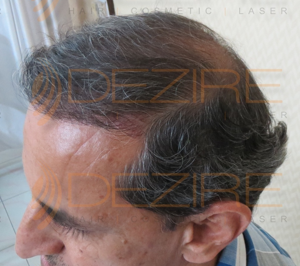 do hair systems work – Hair Transplant Pune