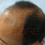 does reverse hair loss program work