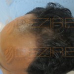 donor area after hair transplant