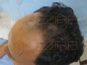 donor area after hair transplant
