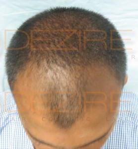 famous hair transplant surgeons in india