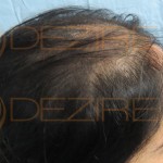 female hair loss best treatment