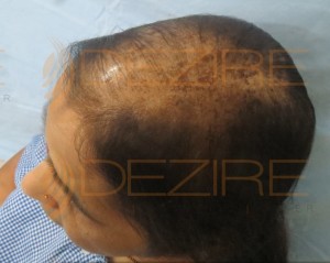 female hair loss pattern
