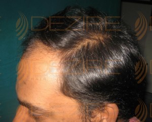 female hair loss treatment