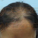 female hair loss treatment diet