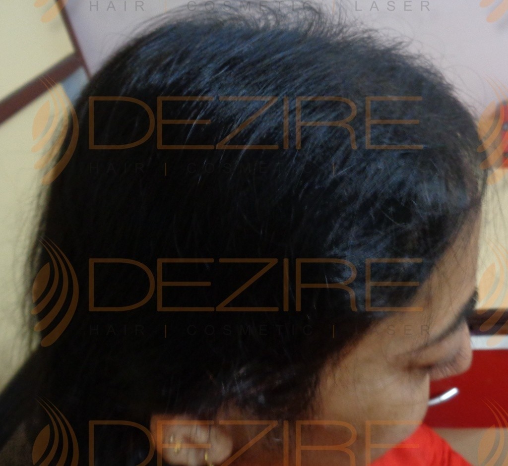 Female Hair Regrowth done at Dezire Clinic Pune | Hair Transplant Pune