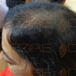 female hair regrowth treatment