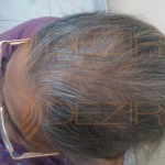 female pattern baldness hairstyles