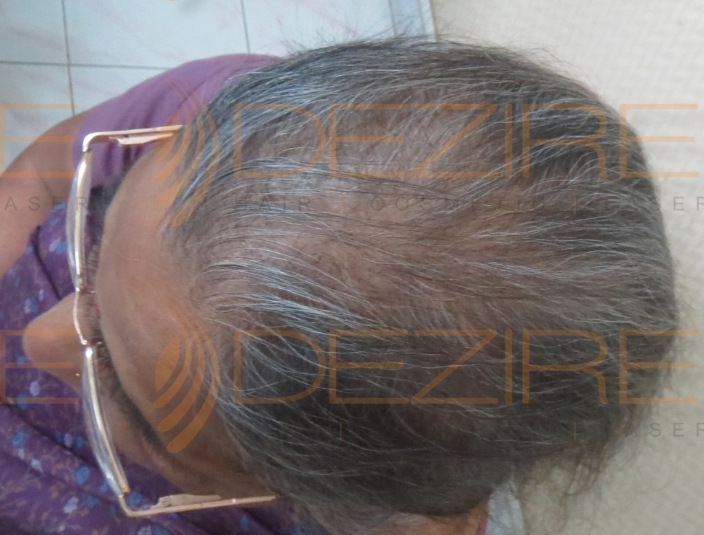female pattern baldness hairstyles - Hair Transplant Pune