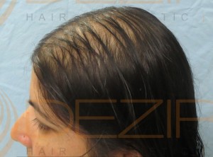 female pattern baldness pictures