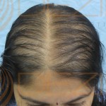 female pattern baldness treatment