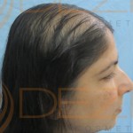 female pattern hair loss reversible