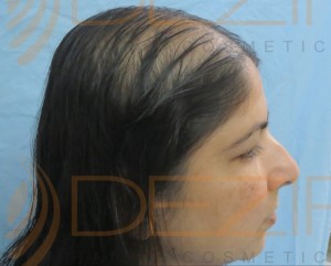 female pattern hair loss reversible