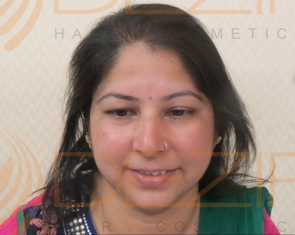 female pattern hair loss success stories – Hair Transplant Pune