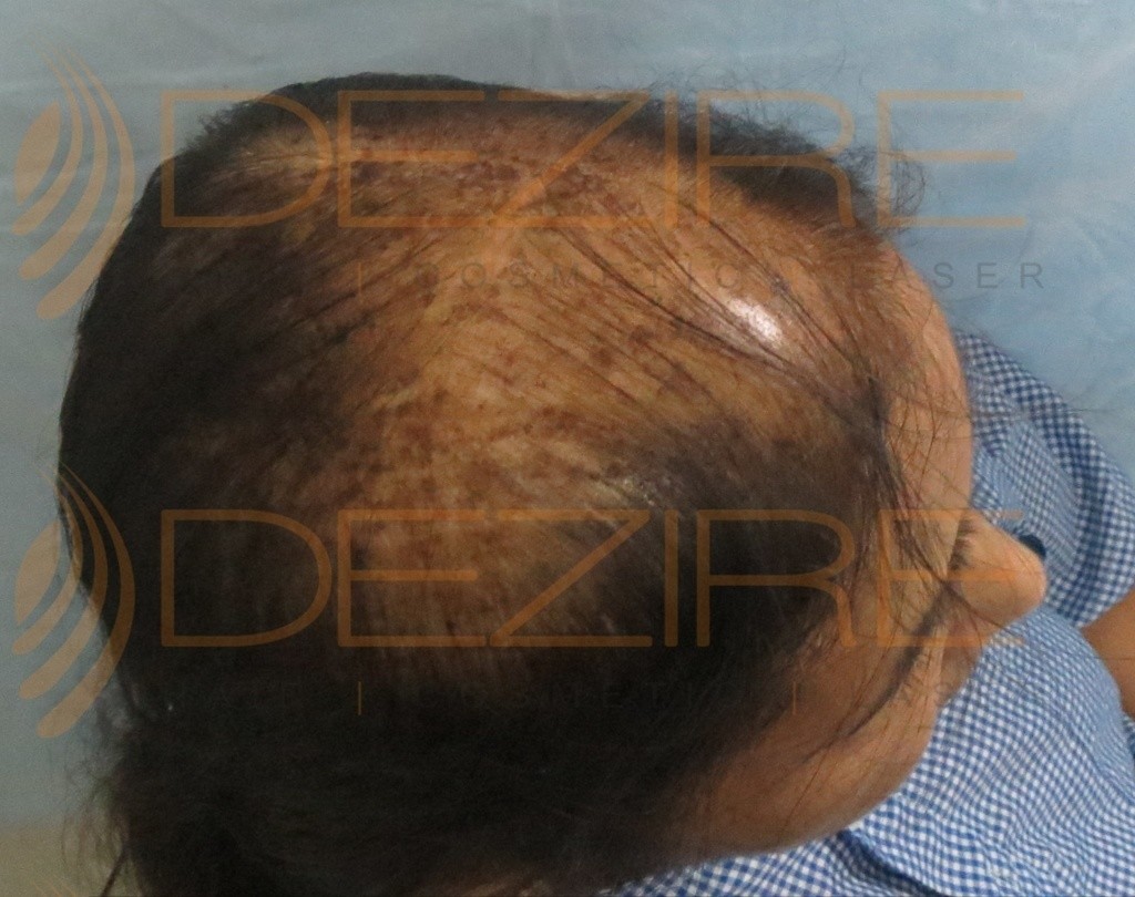 Hair Loss In Women Treatment done at Dezire Clinic Pune | Hair Transplant  Pune