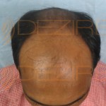 fue hair transplant cost in india