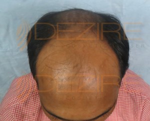 fue hair transplant cost in india