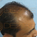 fue hair transplant cost in indiafue hair transplant cost in india