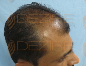 fue hair transplant cost in indiafue hair transplant cost in india