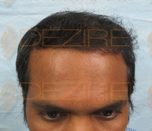 fue hair transplant recovery timeline