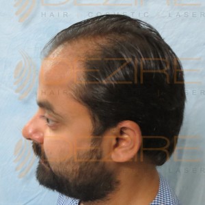fue hair transplant results