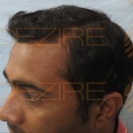 fue hair transplant results after 2 months