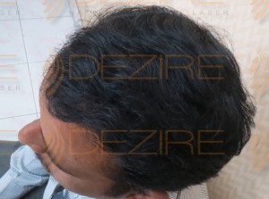 fue hair transplant results after 3 months