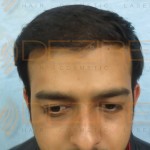 how long after hair transplant for hair to grow