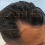 hair Fue, PRP grafting cost