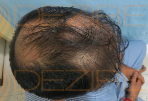 hair follicle infection