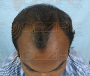 hair follicle replacement reviews