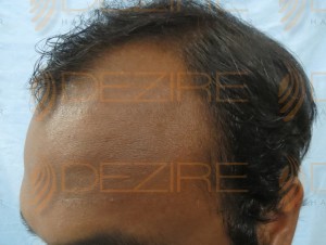 hair follicle replacement surgery