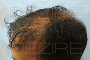 hair follicle transplant before and after