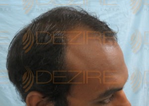 hair follicle transplant cost in india