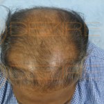 hair grafting cost