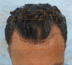 hair grafting cost