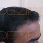 hair regrowth after scalp surgery