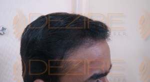 hair regrowth after scalp surgery