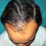 hair regrowth for baldness