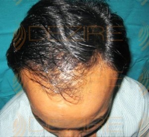 hair regrowth for baldness